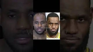 Lebron James Hair Transplant #worbimed #hairtransplant #lebron #lebronjames #nba