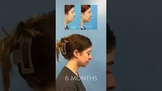 Mini Neck Lift: What does surgery look like? #skincare #cosmeticsurgery #beauty