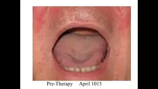 Using Myofunctional Therapy as an Adjunct Treatment Approach to Obstructive Sleep Apnea OSA