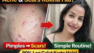 Acne & Scars Stop Guide