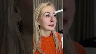 Sensational case of facial harmonization, very natural!