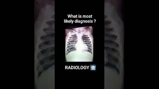 The most likely diagnosis based on the provided image, is cardiomegaly or tuberculosis.&nbsp;