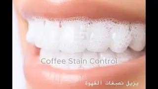 Advanced Teeth Whitening and Stain Removal Using  Dubai ONOSONIC Technology