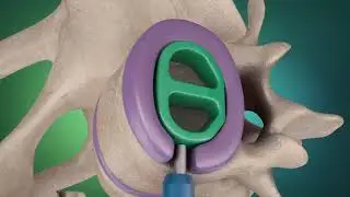 OZOP Surgical: BLIF Technique
