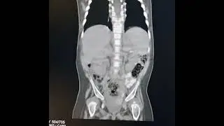 Arthrogryposis multiplex congenita. Coronal images showing Developmental dysplasias of hip joints.