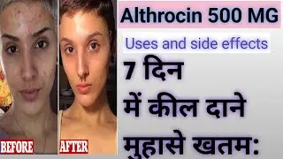 Althrocin 500Mg Tablet Uses And Side Effects || Treat Pimple