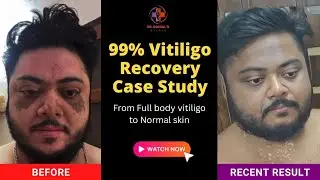 From Full body vitiligo to Normal skin | 99% Vitiligo Recovery Case Study | #vitiligotreatment