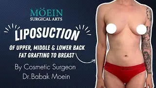 Full Back Liposuction & Fat Grafting to Breasts | Natural Sculpting by Dr. Moein