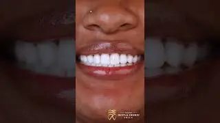 B&A Porcelain Veneers at Our Miami Clinic