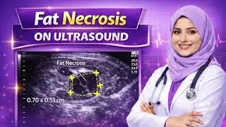 Fat Necrosis On Ultrasound | Health Connection by Doctors 