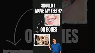 MARPE: Should I move my teeth or bones???