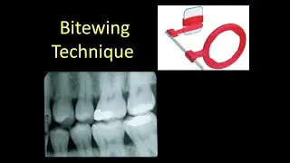 Bitewing Radiography #oralmedicine #radiology #bds #bitewing #dental #xray #intraoralscanner