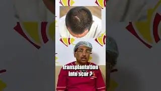 Can You do Hair Transplant on Scars? Venkat Centre Bangalore #hairtransplant #haircare