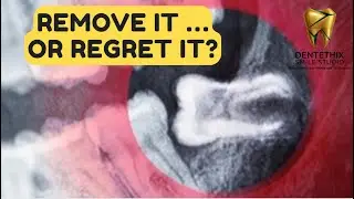 Wisdom Tooth Pain? When to Remove It & What Happens If You Wait | Dentist Explains