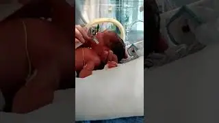 Twins born in 28 Weeks. Extremfr&uuml;chen. Zwillinge geboren in der 28 ssw. Per not Sectio.