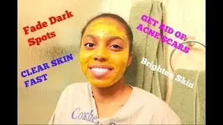 Diy Turmeric Mask | Get Rid Of Acne Scars FAST and Naturally