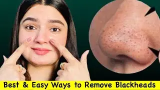 Easy ways to REMOVE Blackheads At Home  | Clear Skin 