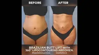 Brazilian Butt Lift | 360 Degree Lipo-Contouring Abdomen Procedure