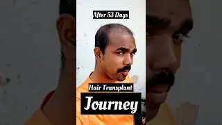 Hair Transplant Journey 53 Days Complete 🥰❤️🤗 #hairtransplant @D2LifeVlogging