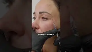 Face filler #facefiller #dermalfillers #fillerinjections