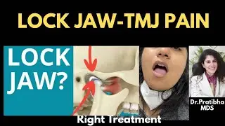Lock Jaw from TMJ DISORDER treatment #shorts #viralvideo #trending #smilemakeover #lockjaw #tmjpain 