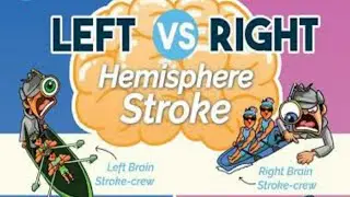 Left vs Right Brain Stroke: Key Differences & Warning Signs