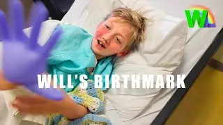 Will's Birthmark | Port Wine Stain Laser Surgery