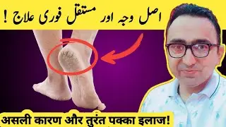 The Real Causes & Cure Of Cracked Heels