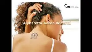 Alpharetta Tattoo Removal