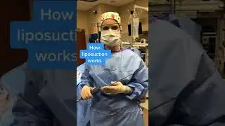 Как работает липосакция? | Greer Plastic Surgery