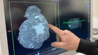 A First in Washington: Real-Time 3D Cancer Imaging at OMC