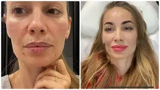 УВЕЛИЧЕНИЕ ГУБ 💋 МОЙ ЛИЧНЫЙ ОПЫТ 👄 ФОТО и ВИДЕО