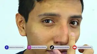 Nariz grande y desviada 👃🏼 RINOPLASTÍA estética y funcional ❤️ Dr PERCY NEVADO