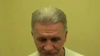 Los Gatos Hair Restoration Excellent Result Balding Man 1 Year Follow Up Dr. Diep www.mhtaclinic.com