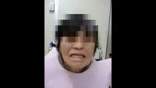 Oral dyskinesia before and after denture adjustment