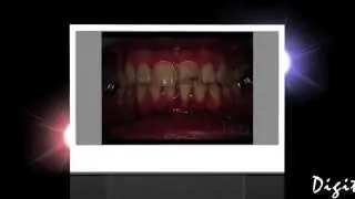 From Digital Smile Design to Predictable Waxup