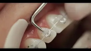 Bráquete Cerâmico Autoligado Iceram SLB - Orthometric