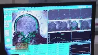 New Non-Invasive Treatment Helping Essential Tremors Sufferers