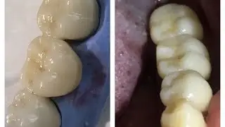 Dental Bridges Zirconia Vs PFM | Gigi Palsu Jembatan | Dokter Gigi Riesqi
