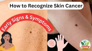 How to Recognize Skin Cancer Early Signs Symptoms