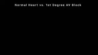 1st degree heart block 