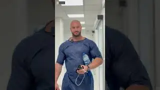 Second Hair Transplant Plan for a Fitness Coach - Dr. Resul YAMAN