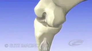 ACL Repair - Medical & Scientific Video Production