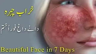 Kharab Chehra Dany Dagh Foran Khatam Beautiful Face in 7 Days