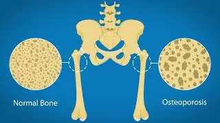 Functional Medicine - Bone Density