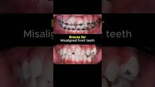 Braces transformation. Fix extremely misaligned front teeth #braces #dentist #orthodontist #teeth