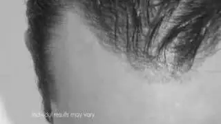 Hair Loss | Hair transplant FUE Patient Story - Los Angeles, CA