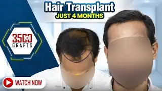 సహజమైన జుట్టు ఫలితం | Hairfree & Hairgrow Hyderabad | BIO-FUE Hair Transplant Success