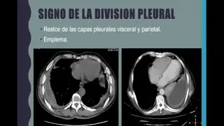 Signos radiologícos de patología torácica Dra. Estefanía Salinas