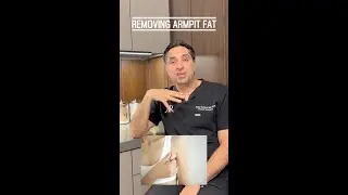 Removing 
